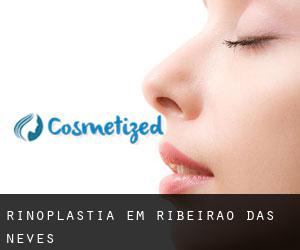 Rinoplastia em Ribeirão das Neves Rinoplastia em Ribeirão das Neves