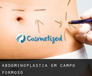 Abdominoplastia em Campo Formoso Abdominoplastia em Campo Formoso