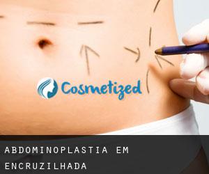 Abdominoplastia em Encruzilhada